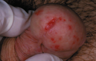 balanopostitis gombás bőrgyulladás